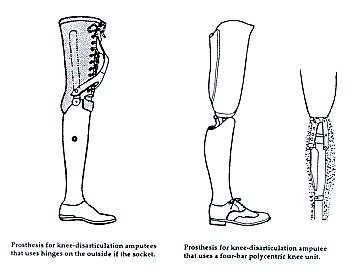 Knee Disarticulation Prostheses A Manual For Above Knee Amputees